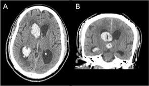 The Csf Diversion Via Lumbar Drainage To Treat Dialysis Disequilibrium Syndrome In The Critically Ill Neurological Patient Springerlink