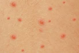 Zona, (herpes zoster) deride ağrılı döküntülere neden olan bir sinir iltihabıdır. Varicela Ce Trebuie Sa Stim Despre Transmitere Simptome Complicatii Tratament Si Preventie Medlife