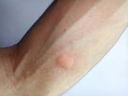 It is most commonly spread to people by the bite of an infected mosquito. Muckenstich Borreliose Juckreiz Baby Reaktion Allergie Salbe