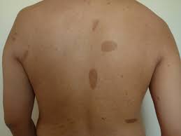 Image result for Macule