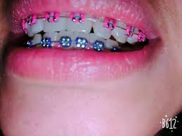 Black And Light Blue Braces Pin By Amaiyagaines On Braces Colors In 2020 Braces Teeth Colors Cute Braces Pink Braces
