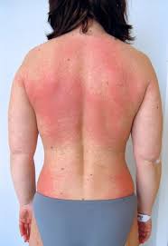 Heliotrope Rash-Myositis- Dermatomyositis-Causes-Diagnosis-Treatment | Homeopathic | Best Homeopathic Doctor in Pakistan | Dr Qaisar Ahmed MD, DHMS