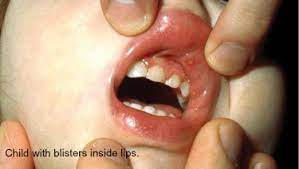 There is no treatment that will take away the virus. Hand Foot Mouth Disease Parent Faqs Healthychildren Org