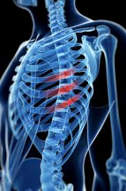 Pain under your left breast or rib cage can be really scary, especially if you're worried you might be having a heart attack or other medical emergency. Fractured Ribs Still Painful After 2 Months You May Need Surgery University Of Utah Health