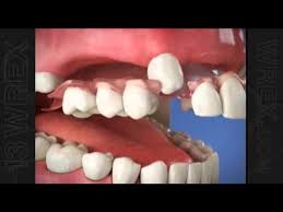 Don't wait to feel great smiling. Flexible Partial Dentures Youtube
