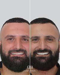 Before and after veneer treatment. After image taken 2 weeks  post-treatment. Please note results shown are specific to this patient and  will vary for each individual. All images and videos