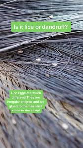 Image result for lice vs dandruff