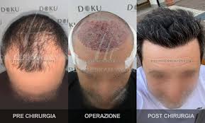 Gonfiore intorno al viso e principalmente intorno agli occhi può capitare raramente per un alcuni giorni post intervento. Galleria Trapianto Capelli Turchia