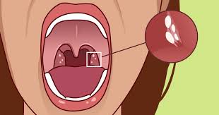 Did You Know Your Tonsils Could Be Giving You Bad Breath Here S How To Fix It Causes Of Bad Breath Bad Breath Bad Breath Treatment