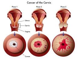 This testing can be another pap test, an hpv test, or a colposcopy — a procedure that helps your doctor look more closely at your cervix to see if there. Higher Cervical Cancer Rates Baseline Of Health