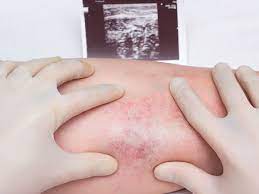 Deep vein thrombosis, also known as thromboembolism and postphlebitic syndrome, is a critical and sometimes fatal blood condition that occurs when blood clots form in various parts of the body, typically in a leg or the lower half of the body. Que Es La Trombosis Venosa Profunda Revista Salud Y Cardiologia