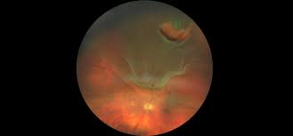 Diabetic retinopathy, by replacing cloudy vitreous and helping your doctor find and repair sources of bleeding in the retina; Retinal Tears And Detachments Navkar Eye And Smile