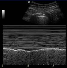 Diffuse nodules and opacification in right lung with compressive atelectasis. 2 Lung Ultrasound Pre Reading For Fcus Course Intensive Care Network