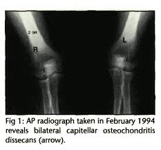 Image result for Ballottable Patella Sign