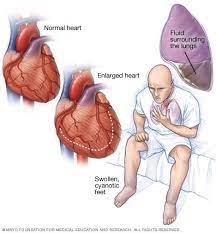 Learn how it leads to heart attacks and strokes, and what you can do to reduce inflammation. Heart Failure Symptoms And Causes Mayo Clinic