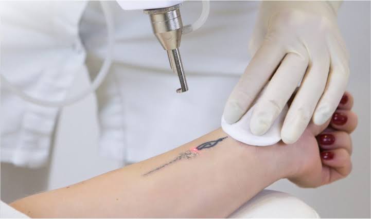Laser Tattoo Removal| Book Appointment Today
