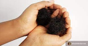 Tension from braids, twists, and weaves can cause permanent follicle damage, especially to the baby hair around the perimeter. African American Women Hair Loss Get The Facts A Diva S Hidden Hair Manufacturer