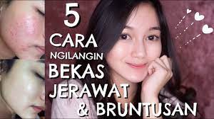 Ada cara menghilangkan jerawat yang tidak membahayakan. Randomtalk 6 5 Cara Cepat Menghilangkan Bekas Jerawat Bruntusan Youtube