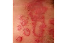 দাদ এর চিকিৎসা এর ছবির ফলাফল