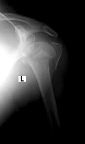 Parsiyel Omuz Protezi Prof Dr Erdem Bagatur