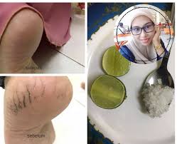 Telapak kaki yang kulitnya terasa kaku dan kering kerap menimbulkan rasa tidak nyaman orang dengan jenis kulit kering cenderung lebih mudah mengalami hal ini dan berikut adalah sejumlah. 7 Cara Hilangkan Kesan Tumit Kaki Merekah Wanita Ni Amalkan Satu Daripadanya Memang Menjadi Keluarga