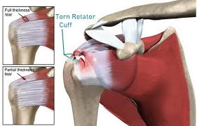 Functional anatomy of the shoulder. Torn Rotator Cuff Symptoms And Treatment Shoulder Pain Explained