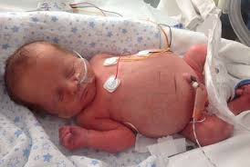 Beberapa waktu lalu, di web ini kita sudah pernah membahas tentang hukum melakukan masturbasi atau onani dalam pandangan fiqih baca di sini. Kisah Miley Bayi Yang Perutnya Bengkak Sejak Masih Di Kandungan