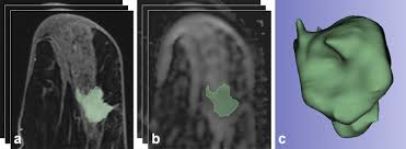 An mri can be used to look for a disease, such as breast cancer. Radioproteomics In Breast Cancer Prediction Of Ki 67 Expression With Mri Based Radiomic Models Academic Radiology