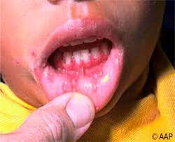 Infection with herpes simplex virus (hsv) is one of the most common infections in the world—and one of the most confusing. Herpes Simplex Viruses 1 And 2 American Academy Of Pediatrics