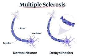 The term multiple sclerosis refers to the distinctive areas of scar tissue (sclerosis—also called plaques or lesions) that result from the attack on myelin by the immune system. How Does Multiple Sclerosis Affect The Body Ausmed