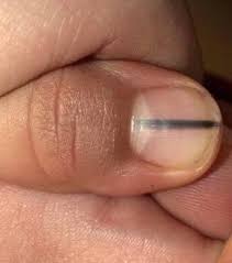 A black spot under a nail could mean several things. This Woman S Manicurist Spotted A Tell Tale Sign Of Deadly Skin Cancer Under Her Fingernails Allure