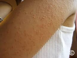 Image result for Keratosis pilaris