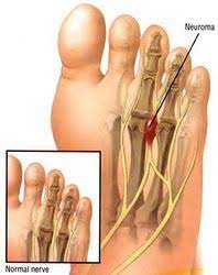 Mortons Neuroma Symptoms And Fixes Fellrnr Com Running Tips