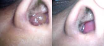 The exact cause of nasal polyp is unclear. Adenoid Homeopathic Treatment Nasal Polyp