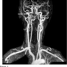 Carotid artery dissection is a tear in one of the layers of the artery wall. Figure 3 From A Patient With Internal Carotid Artery Dissection Semantic Scholar