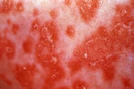 Image result for Candidiasis under breasts