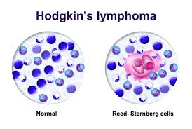 Hodgkin's disease hodgkin's lymphoma is a malignant tumour of the lymphatic system that is characterised histologically by the presence of multinucleated. Kanker Darah Limfoma Mount Elizabeth Hospitals Singapura