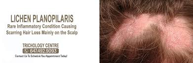 Lichen planopilaris (llp) is a type of cicatricial alopecia (scarring alopecia) that occurs when a relatively common skin disease, known as lichen planus, affects areas of skin where there is hair. What Is Lichen Planopilaris Trichology Centre Toronto