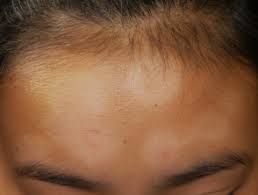 Homeopathic medicines for pityriasis alba help to halt further progression of complaint and recover from spots already present. Bilder Von Pityriasis Alba Dermatly Com Die Website Ihrer Haut