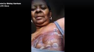 Maybe you would like to learn more about one of these? This Is What Cancer Does J Can Woman Shows Ugly Side Of Breast Cancer To Raise Awareness Loop Jamaica
