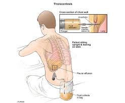 Image result for Thoracentesis
