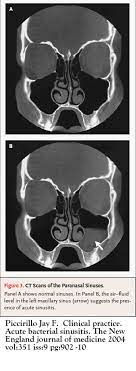 Sinusitis Cancer Therapy Advisor