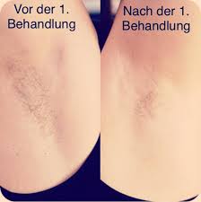 22 j/cm2) können sie bereits 3 wochen nach der ersten behandlung sichtbare ergebnisse erzielen. Bikinizone Lasern 2021 Alles Was Sie Wissen Mussen