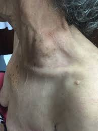 To check your supraclavicular lymph nodes, you should stand in front of a mirror and press gently on both armpits. Virchow Node The Gastrointestinalatlasl Gastrointestinalatlas Com