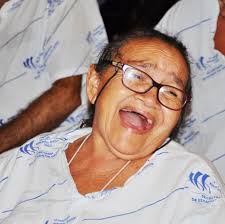 HGG realiza cirurgia rara de hemangioma gigante