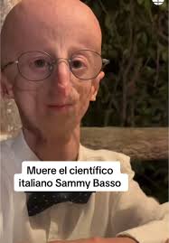 Muere Sammy Basso, la persona con progeria más longeva Con dos años le  diagnosticaron la progeria de Hutchinson-Gilford, una enfermedad genética  extremamente rara y que solo afecta a 1 de cada 20 ...