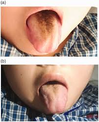 Image result for black hairy tongue symptoms
