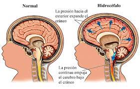 Si un bebé con espina bífida tiene hidrocefalia (agua en el cerebro), el cirujano puede implantar una válvula —un pequeño tubo para extraer fluido— para drenar el líquido adicional y así aliviar la presión en el cerebro. Hidrocefalia Sintomas Tipos Y Tratamiento