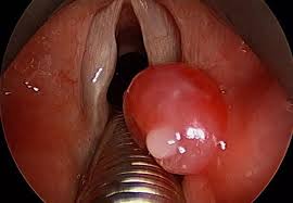 Image result for Pyogenic Granuloma