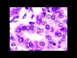 Check spelling or type a new query. Lab Or Diagnostic Findings Orphan Annie S Eyes Nuclei Papillary Carcinoma Of The Thyroid Youtube